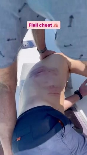 Inside Human Body/Medical | This is the best video of flail chest I’ve ever seen | Instagram