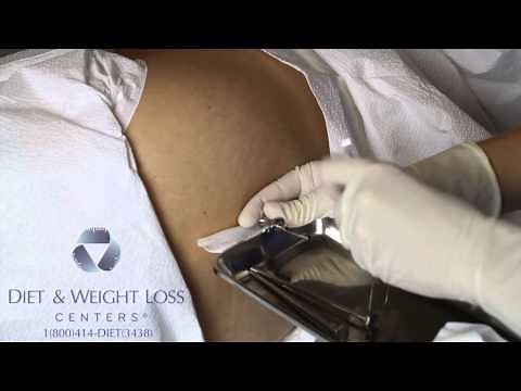 Hormone Pellet Insertion Procedure - ThinWorks Weight Loss Centers
