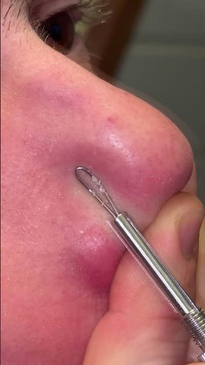 Remove blackheads on the nose with Remos comedone extractor with loop