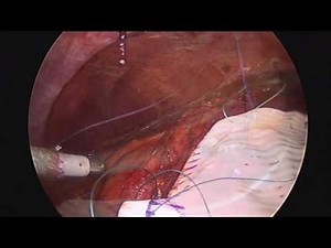 Incisional Hernia Laparoscopic Repair  • Video • MEDtube.net