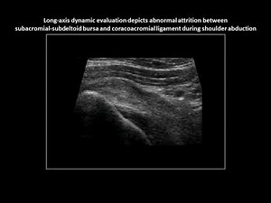 Subacromial impingement on dynamic real-time shoulder ultrasound (case 5)