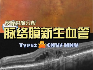 【多模影像】【2型MNV】2型脉络膜新生血管CNV：Multimodal analysis of Macular Neovascularization