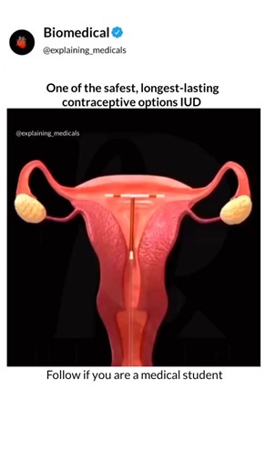 Explaining Medicals on Instagram: "Follow @explaining_medicals ⬇️⬇️⬇️⬇️ What text books can't show you, We animate. The IUD is a small T-shaped device placed inside the uterus by a gynecologist in a quick, safe procedure. It is one of the most effective methods to prevent pregnancy. Insertion takes only minutes and may be done with local anesthesia or light sedation. The Copper IUD is hormone-free and releases copper ions that alter the uterine environment, preventing sperm from reaching the egg
