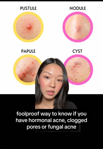 detailed breakdown on how to tell the difference between hormonal acne, clogged pores, and fungal acne #hormonalacne #cloggedpores #texturedskin #fungalacne
