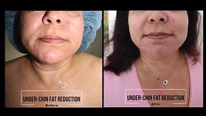 MESOESTETIC Double chin sculping treatment with our LPG Endermolift technology & Tripolar Radio frequency. Amazing results from the very first session. 100% satisfaction. Price: one session LPG & Tripolar RF fl 414,- Three session LPG & Tripolar RF fl.1034,- Beauty gives confidence. Adres: salinja galleries 204 Tel. 4653308 - 4653308 | Mesoestetic Curaçao