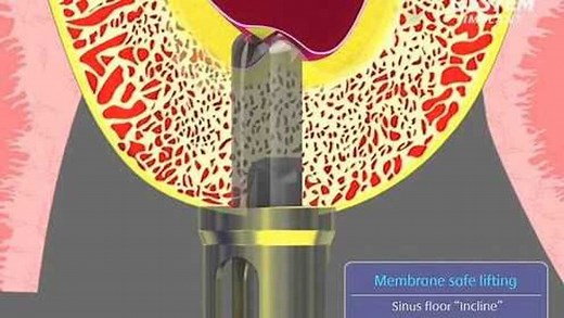 奥齿泰CAS-KIT上颌窦内提升工具盒