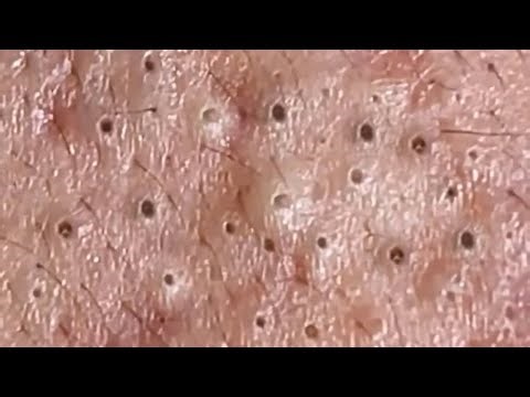 "Satisfying Blackhead & Whitehead Removal! 😲 Pimple Popping | Acne Treatment Compilation" #0052