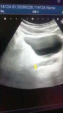 Bladder Stone on Ultrasound | Urethral Stone Case Explained LIVE Scan