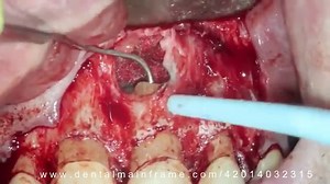 Anterior Periapical Surgery-dental