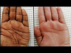 Lighten And Soften Your Palm With Lactic Acid.