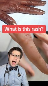 What is this rash? What is dyshidrotic eczema? How to treat dyshidrotic eczema? General educational purposes only. Not specific medical advice. #eczema #rash #doctor | Zachary Rubin, MD
