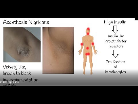 Acanthosis nigricans - Velvet skin discoloration. Causes and Treatment of acanthosis Nigricans