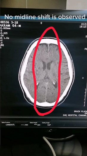 finding of Head | how to read CT Brain | Medical Imaging | Diagnosis of CT