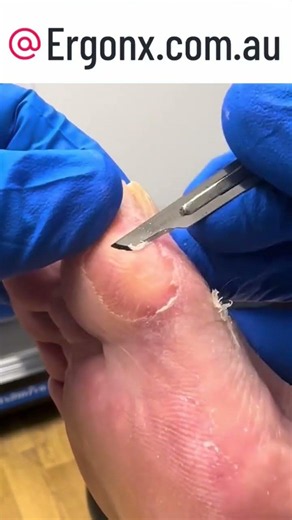 Work Boots Woes: How to Fix Big Toe Calluses Fast #FootCare #WorkBoots