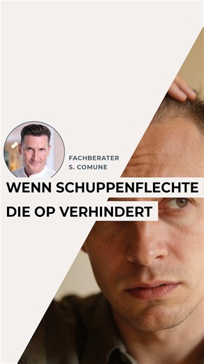 Schuppen oder Schuppenflechte vor der Haartransplantation? 🩺 Solltest du am OP-Tag sichtbare Schuppen oder eine Schuppenflechte auf der Kopfhaut haben, müssen wir dich leider wegschicken – denn eine gesunde Kopfhaut ist Voraussetzung für eine erfolgreiche Transplantation. Die gute Nachricht: Du kannst präoperativ ganz einfach vorsorgen ✅ 🔹 Termin beim Dermatologen → kortisonhaltiges Shampoo oder Creme verschreiben lassen 🔹 Oder: Ketoconazol-Shampoo (rezeptfrei in der Apotheke) 🔹 7–10 Tage vo
