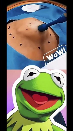 BIGGEST Cyst Popping Like You've Never Seen Before!