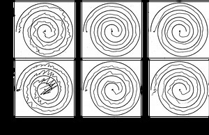 Brain signals deliver first targeted treatment for world’s most common movement disorder