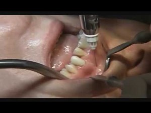 Benex Extraction System