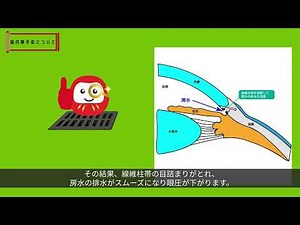白内障緑内障同時手術（線維柱帯切開術（眼外法））の説明