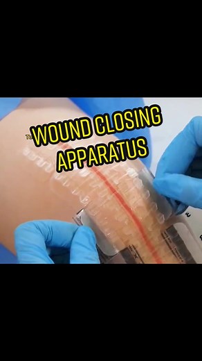 Wound closing apparatus#technology