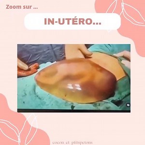 Comment ça se passe à l'intérieur de la poche des eaux ? Une chose est sûre c'est la fête 🥳 💃🕺 La poche est remplie de liquide amniotique dans lequel le bébé baigne, c'est un coussin protecteur des chocs externes, du froid. Il favorise les mouvements actifs du fœtus, le développement de sa motricité, ainsi que le développement des sens, le goût, l'odorat et l'audition. Mais surtout, il a un rôle antibacterien très important... La poche des eaux peut se rompre spontanément pendant le travail, 