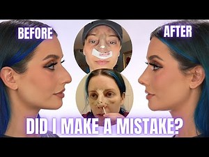 CLOSED RHINOPLASTY NOSE JOB VLOG | SURGERY DAY, DAY BY DAY RECOVERY & CAST REMOVAL REVEAL