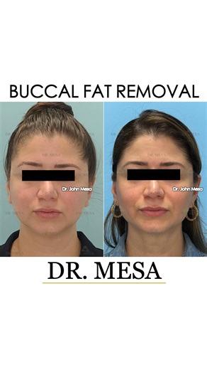 Tired of that round face making you look heavier than you are? Buccal fat removal can sculpt those defined cheekbones you’ve been dreaming of, all in under 45 minutes under local anesthesia. My technique creates the coveted V-shaped look with minimal downtime, so you can get back to your life looking refreshed and refined. Here’s what this transformation can give you: • ✨ Sharper, more defined cheekbones • 🔻 A slimmer, contoured mid-face • 💎 A feminine, V-shaped appearance • 💉 Quick procedure
