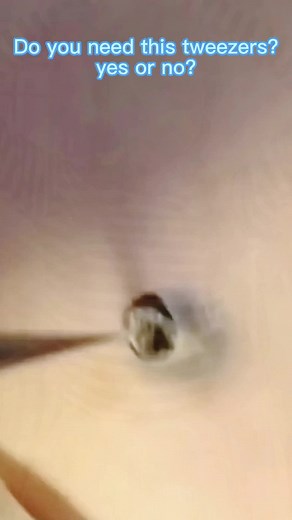 #pimple #pimplepopp #pimplepopper #acne #acnetreatment #pimplepopper2021 #satisfyingvideo #cystpopping #removal #skincare #fyp #pimplepopper2022 #tiktok