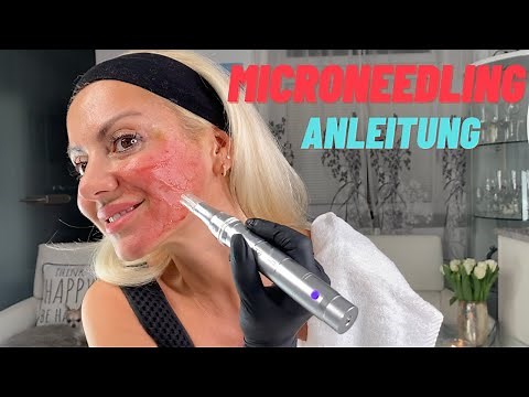MICRONEEDLING INSTRUCTION - Does it really work? | Self test