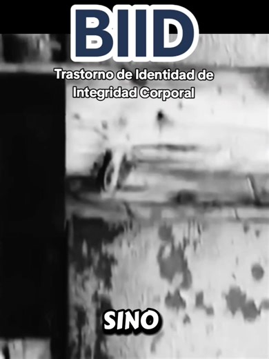 Trastorno de Identidad de Integridad Corporal (Body Integrity Identity Disorder, BIID). En este cuadro, la persona siente que una parte de su cuerpo “sobra” o “no le pertenece”, y puede obsesionarse con la idea de perderla. Algunos buscan amputaciones médicas; otros llegan a provocárselas ellos mismos, lo que es peligrosísimo. A veces el impulso tiene un componente sexual (cuando la amputación o la discapacidad genera excitación), pero otras surge de una distorsión profunda de identidad corporal