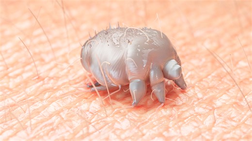 Highly contagious condition where microscopic mites burrow underneath your skin sees sharp rise