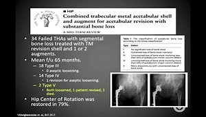 Managing Pelvic Bone Loss and Discontinuity
