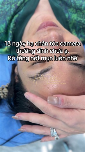 13 ngày hạ chân tóc camera thường đỉnh chưa ạ. Rõ từng nốt mụn luôn nhé