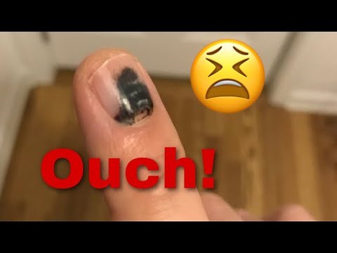 Smashed Finger Healing (Time-Lapse)