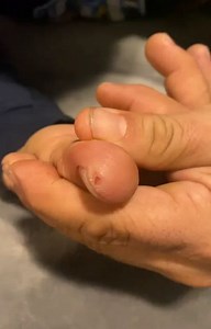 홋홞홢홥홡홚 홋홧홤환홚홨홨 on Instagram: "#pimple #acne #skincare #blackheads #pimples #pimplepopping #pimplepopper #whiteheads #blackhead #blackheadremoval #blackheadextraction #beauty #whitehead #skin #pimplepop #pores #drpimplepopper #jerawat #pimplepoppers #cyst #whiteheadextraction #drsandralee #pimplesremover #zit #jeragat #cystremoval #acnetreatment #zits #whiteheadremoval #bhfyp"