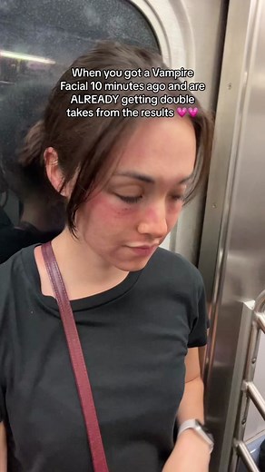 Cant wait to see the actual results!! Thank you Cyma @Velour Medical 💗 #WalkingInNYC #VampireFacial #VampireFacialNYC #microneedlingface #prptreatment