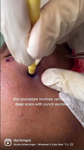 The BEST Way to Get Rid of Boxcar Scars (Acne Scars)