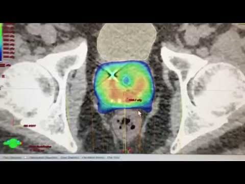 5-Session Radiation Treatment For Prostate Cancer (SBRT or Stereotactic Body Radiation Therapy)
