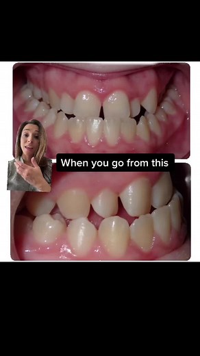 10 Months Braces Transformation: Before and After Progress