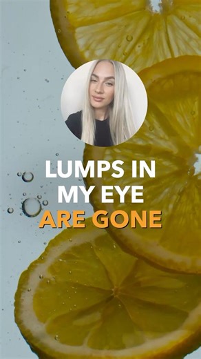 Lumps In My Eye Are Gone