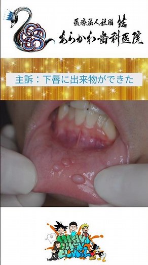 くちびるにできもの！？→病理検査が大事です！ #あらかわ歯科医院