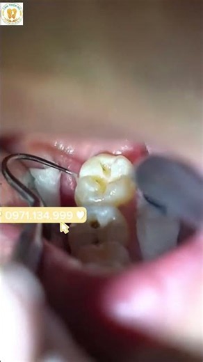 🦷 HÀN RĂNG HÀM THẨM MỸ – PHỤC HỒI RĂNG SÂU, GIỮ TRỌN CHỨC NĂNG ĂN NHAI