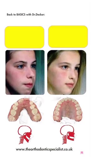 On the right: A child with ideal facial growth. On the left: A child with signs of disrupted development. 🧠 These aren’t just cosmetic differences — they tell a story. Let’s look closer 👇 🔻 Retruded chin 💋 Lip incompetence (lips don’t seal naturally) 📏 Long face syndrome 🦷 Small, underdeveloped jaws 👃 Flattened midface 😬 Mentalis strain (chin muscle working hard to keep lips closed) 🌑 Dark circles under the eyes 📈 Vertical growth instead of forward growth ❓What causes this? Most often,