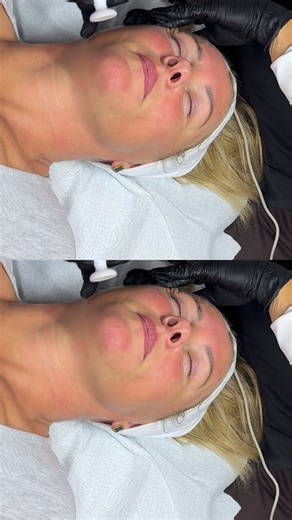 FACIALS & SKINCARE LEEDS on Instagram: "Cold plasma treatment A quick comfortable treatment that can help a variety of skin concerns. *Acne *Teenage acne (from 12 years old) *Dermatitis *Rosacea *Psoriasis *Hyperpigmentation *Long term anti ageing effects *Reduces inflammation Can be used anywhere on the body, which makes this machine unreal. Using plasma shower technology it transforms the main gases in the air between the device and skin, mainly oxygen and nitrogen to cold plasma. Destroying a