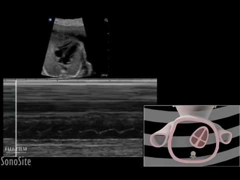 How To: Pregnancy Fetal Viability 3D Video