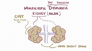 Video: Multicystic dysplastic kidney - Video Explanation! | Osmosis | Osmosis
