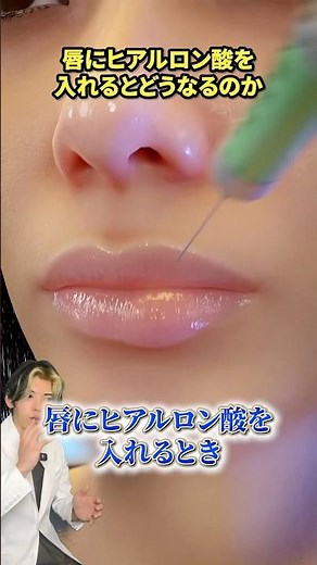 唇ヒアルロン酸の仕組み知ってる？#歯科医師 #歯医者 #マウスウォッシュ #歯列矯正 #歯磨き 審美治療 口腔機能 お口ケア 歯磨き粉 歯ブラシ 歯磨き むし歯 ホワイトニング マウスピース