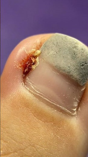 Течёт и ПУЗЫРИТСЯ!😱Что с Ногтем?педикюр ПЕРЕВОПЛОЩЕНИЕ.ДО/После #nails #tutorial #nailart #pedicure