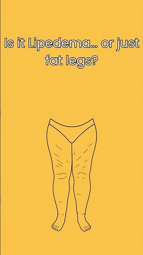 Is It Lipedema or Just Fat Legs? Key Differences Explained