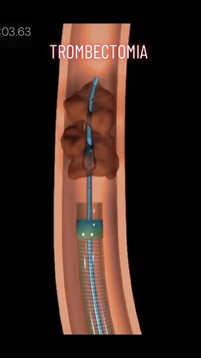 Trombectomia: Procedimento, Tipos, Indicações e Riscos
